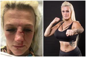 OKRUTNO! Pretučena poznata MMA takmičarka, nakon napada završila u bolnici i sa sedam kopči