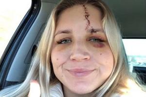 UZNEMIRUJUĆI FOTO: Golman ženske ekipe Liverpula zaradila duboku rani preko pola glave: Rivalka je sasekla kopačkom