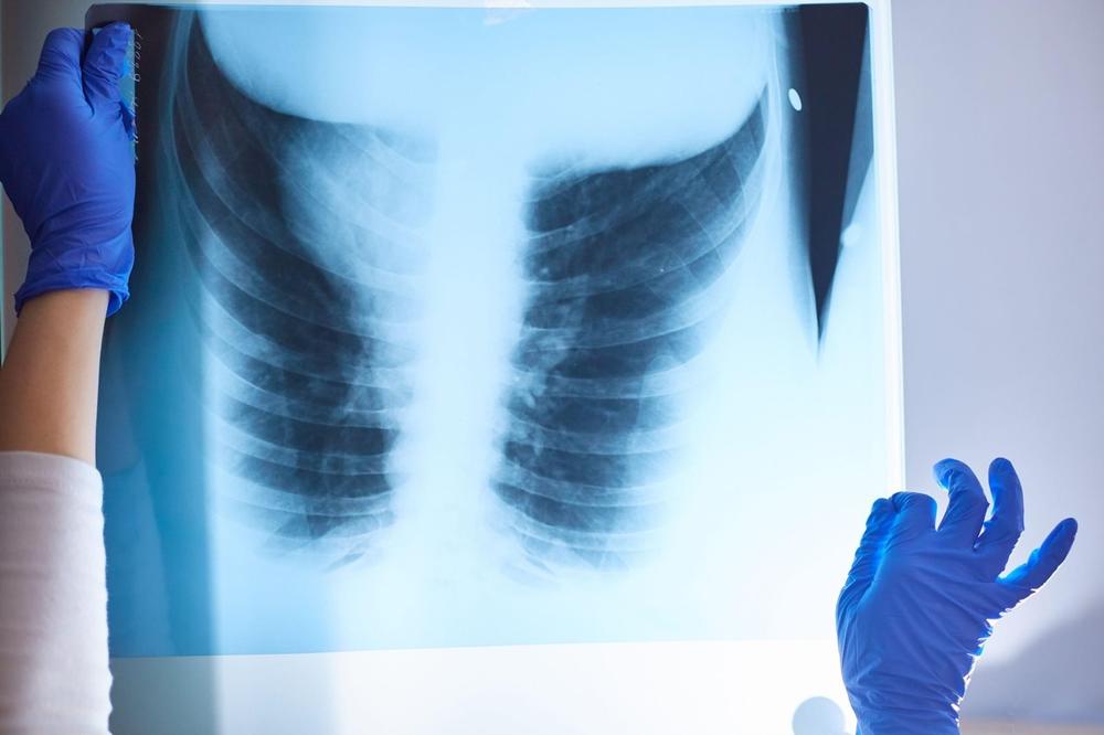 SVETSKI STRUČNJACI OBJASNILI! Evo šta COVID-19 radi našim plućima i koliko se razlikuje od OBIČNE upale pluća