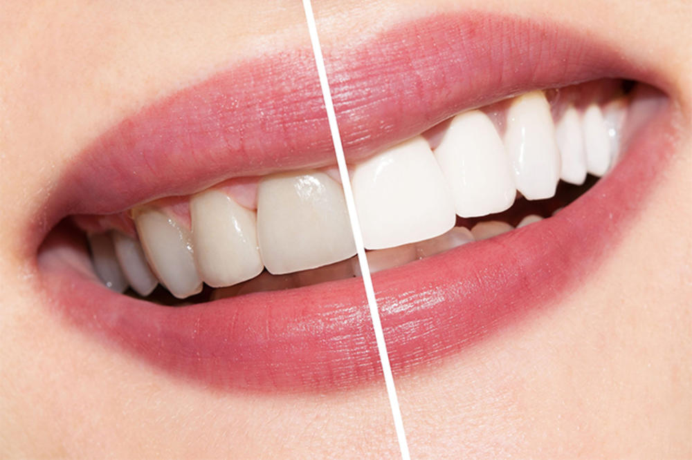 NEGUJTE SE, VAŽNO JE ZA RASPOLOŽENJE: Kako da u izolaciji na zdrav način izbelite zube?