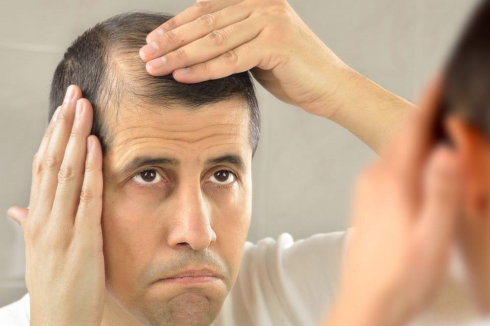 ŠOK! OD KORONA VIRUSA PACIJENTI MOGU DA OĆELAVE: Evo kada opada kosa usled bolesti