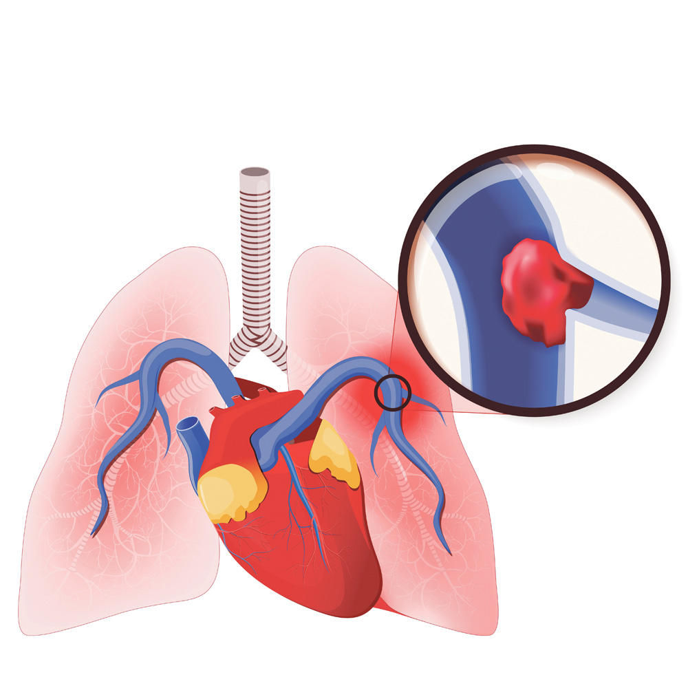 Plućna  embolija Ovako izgledaju pluća sa trombom