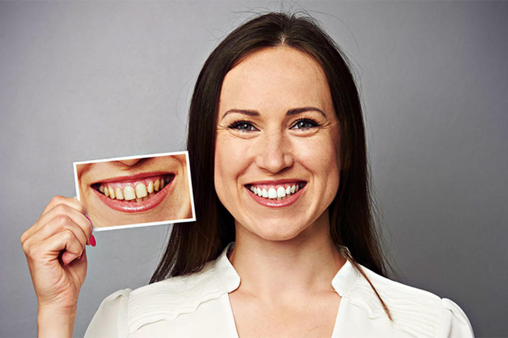 ORALNO ZDRAVLJE I ESTETIKA: Mogu li se zubi stvarno izbeliti BEZBEDNO u kućnim uslovima?
