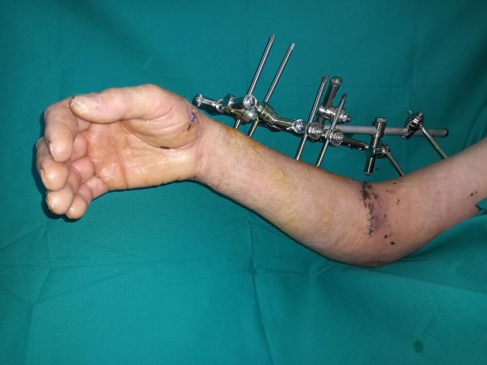 operacija ruke, hirigija, šina, operacihja, spašavanje ruke
