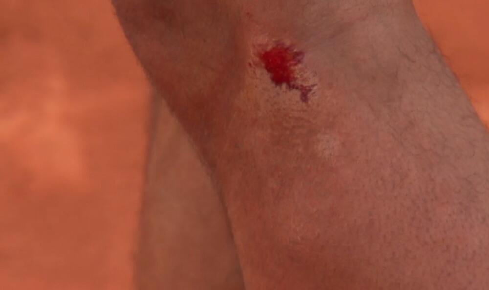 Rafael Nadal, krv, noga