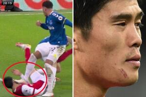BRUTALNO! NOGOM DIRTEKTNO U LICE! Igrač Evertona ZGAZIO Japanca iz Arsenala: Namerno je to uradio! (VIDEO)