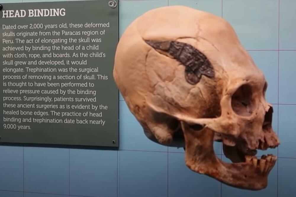 NEVEROVATNO OTKRIĆE Ratnik iz Perua star 2.000 godina imao metalni implant na glavi, preživeo i tu operaciju i izduživanje lobanje