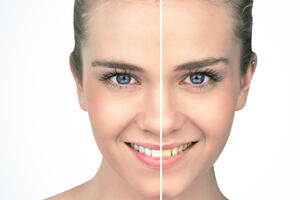 BLISTAV OSMEH BEZ MRLJA: Pogledajte šta može da pomogne kada vam zubi promene boju!