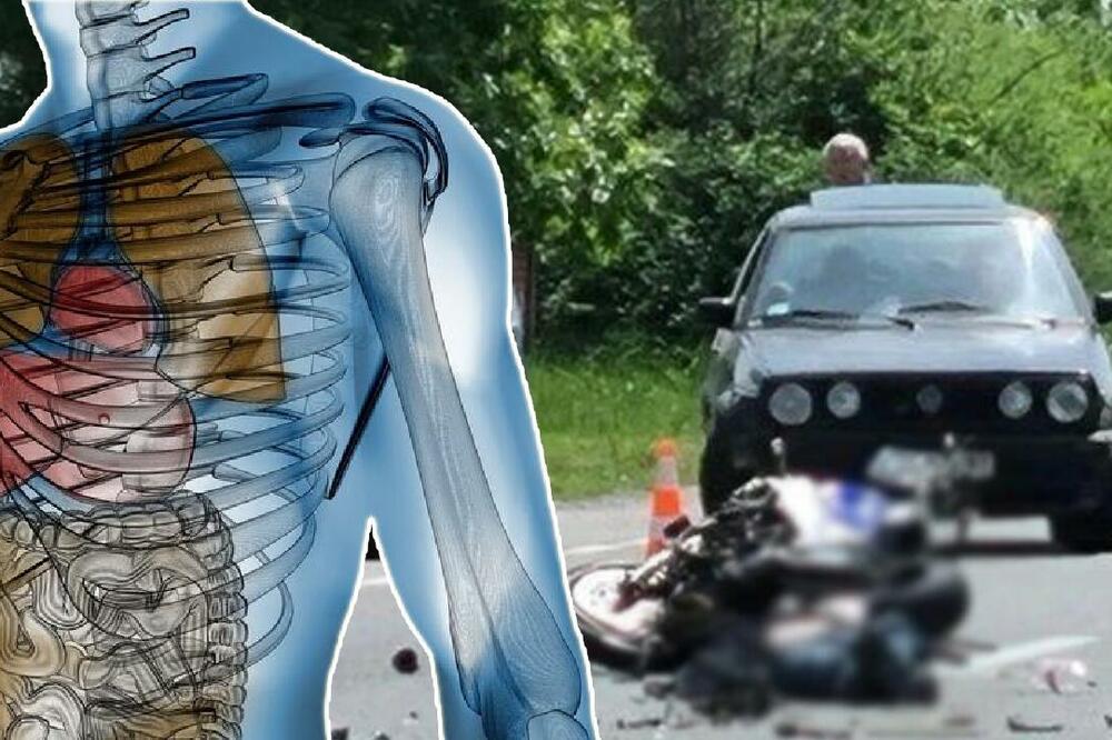 PADOM NAJVIŠE STRADAJU OVI ORGANI! Ortoped šokirao izjavom o nesrećama na motociklu: OPORAVAK JE MUKOTRPAN I TRAJE DO GODINU DANA