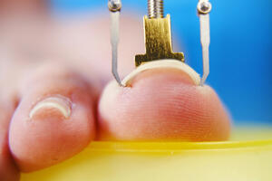 ISKORISTITE LETO I OTVORENU OBUĆU: Rešite problem URASLIH noktiju pre nego što uđete u cipele!