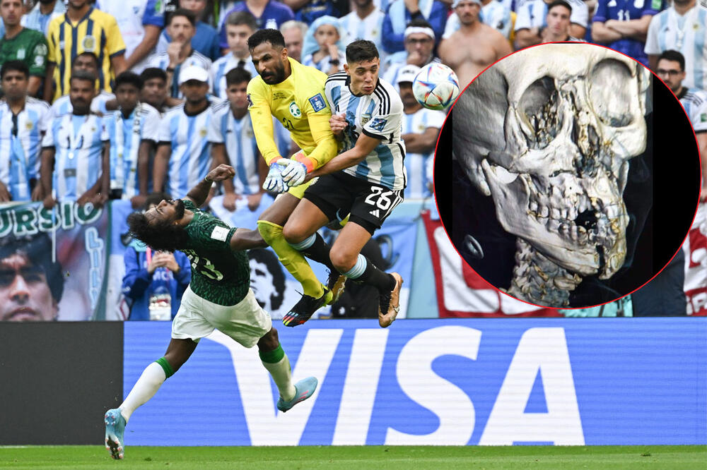 IPSRAVKA: Stravičan rendgen glave ne pripada fudbaleru Saudijske Arabije povređenom na Svetskom prvenstvu
