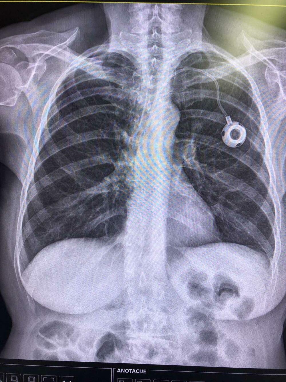 Port na rendgenskom snimku pacijenta