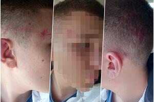 UHAPŠEN ALBANAC KOJI JE PRETUKAO LAZARA (15) U SUVOM DOLU: Oborili ga i šutirali zato što je Srbin, od udaraca ima HEMATOME (FOTO)