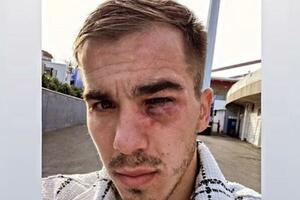 UZNEMIRUJUĆI PRIZOR! Srpski fudbaler doživeo JEZIVU POVREDU, protivnik ga kopačkom udario u lice - evo kako sada izgleda! FOTO