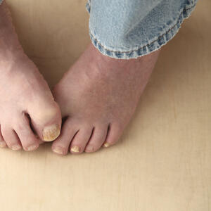 KAKO DA SE REŠITE GLJIVICA: Ne skrivajte vaša stopala, mogu da budu lepa
