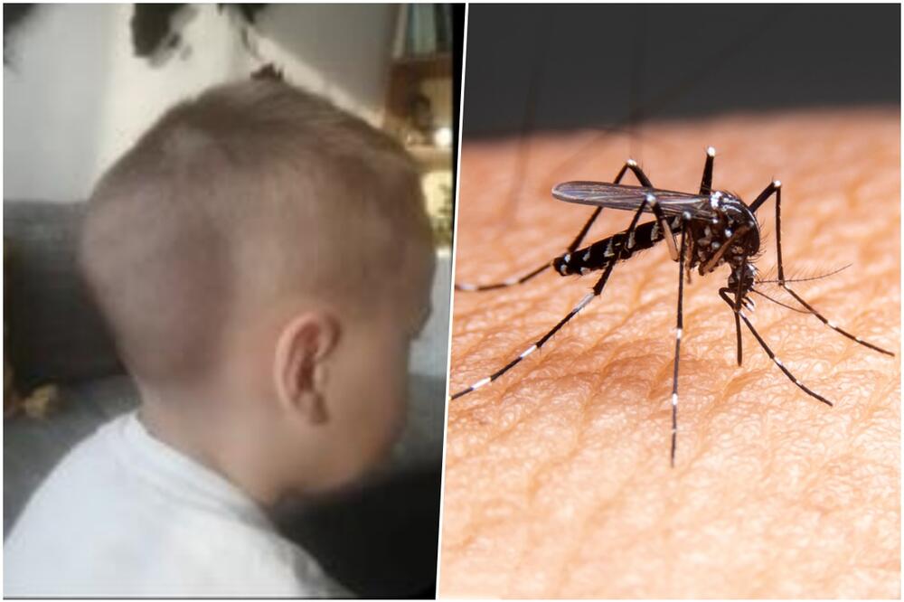 OPASNE POSLEDICE NAJEZDE KRVOPIJA: Trogodišnjem dečaku pola glave oteklo od uboda komarca! Ulaze i u oči (FOTO)