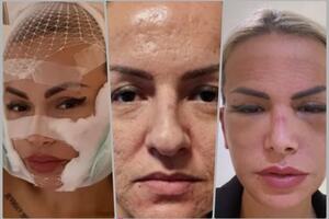 SVA U MODRICAMA I PODLIVIMA: Posle operacije lica sva se izobličila i deformisana, Ermina Pašović sad želi samo jedno! FOTO