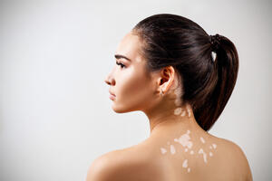 5 MOGUĆIH UZROKA VITILIGA: Kada koža oslikava unutrašnje stanje organizma