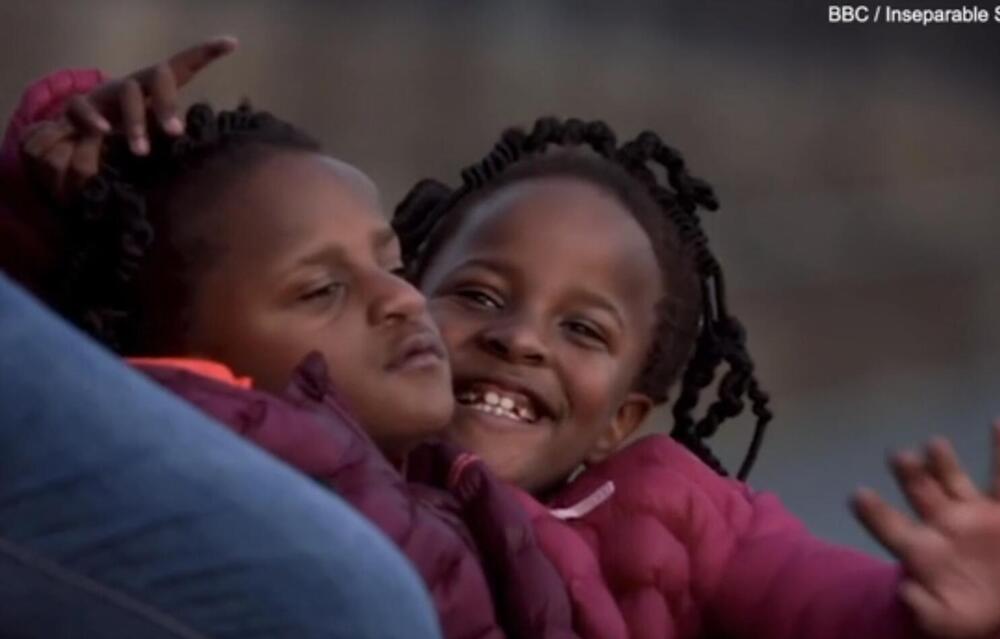 Senegal, sijamski blizanci, Ndeje bliznakinje