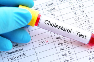Sve što treba da znate o holesterolu: Za loše rezultate krvi nije kriva samo hrana